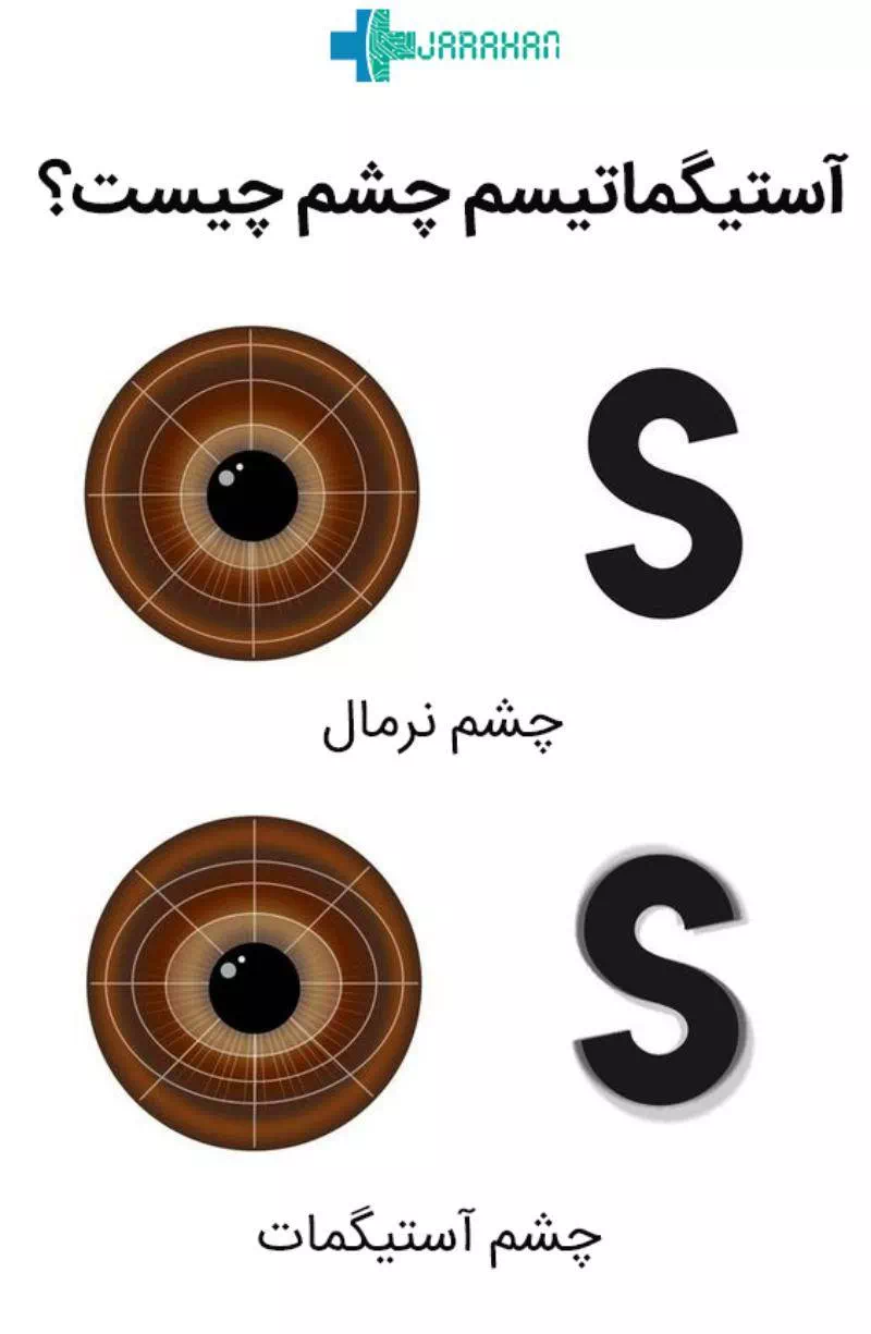 بهترین راه درمان آستیگماتیسم چشم چیست؟ - جراحان