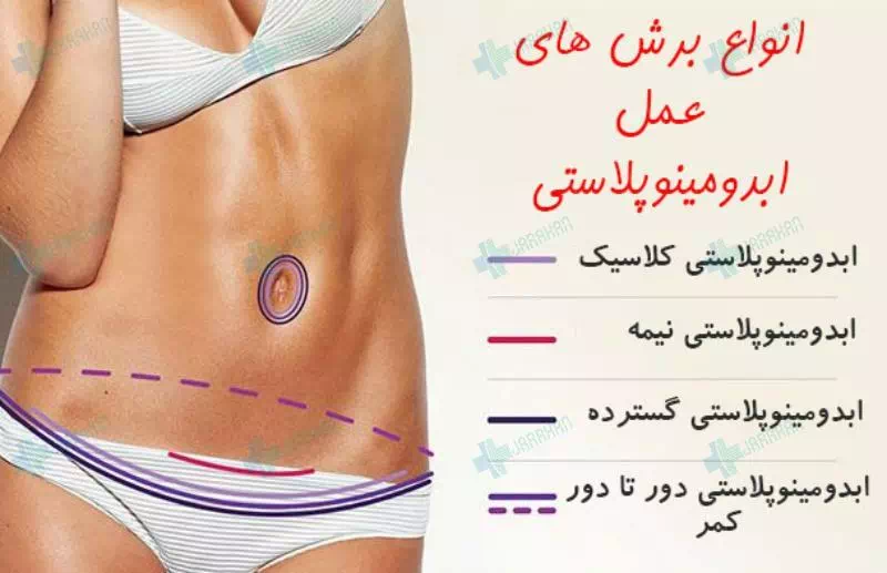 چقدر قبل از عمل نباید سیگار کشید+بعد از عمل ابدو چه لباسی بپوشیم+چرا بعد عمل ابدو شکم ورم دارد+چه مدت بعد از ابدو میتوان سکس داشت