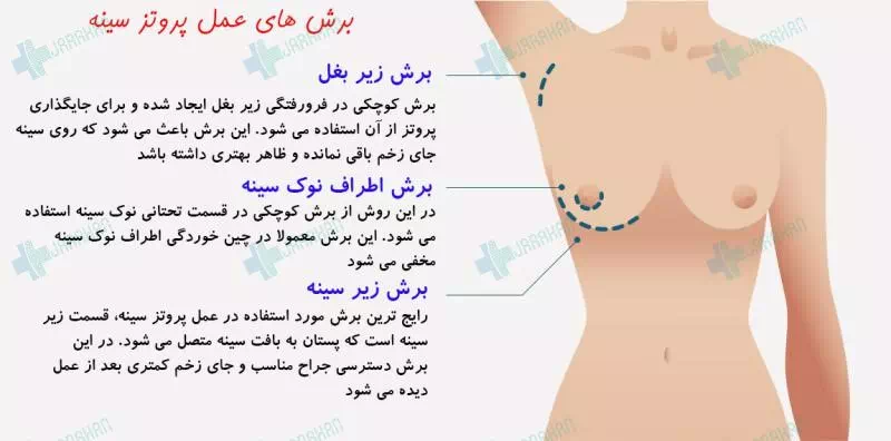 نظرات در مورد عمل پروتز سينه+سوتین طبی بعد از پروتزسینه+سوتین لیفت کننده چسبی+ماندگاری فیلر باسن+نظرات در مورد فیلر باسن