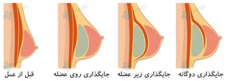 فیلم عمل پروتز سينه زیر عضله+پروتز سینه سایز ۸۵