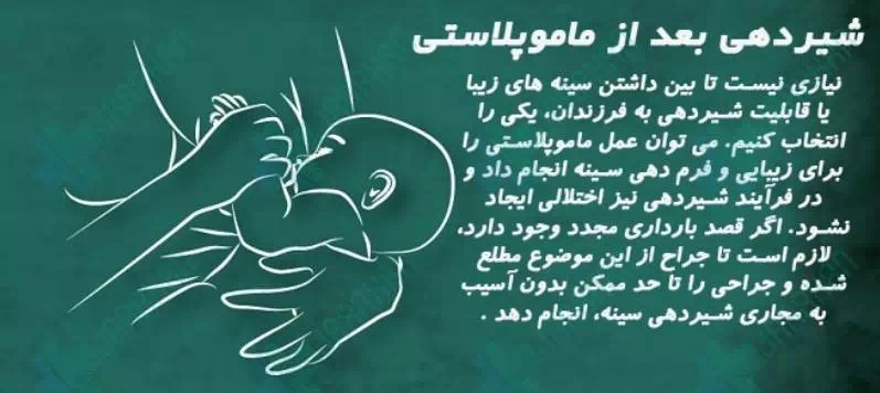 عمل ماموپلاستی چقدر طول میکشد+آیا بعدماموپلاستی می‌توان رابطه داشت+ماموپلاستی با بیمه تکمیلی انجام می‌شود+ماموپلاستی و شیردهی
