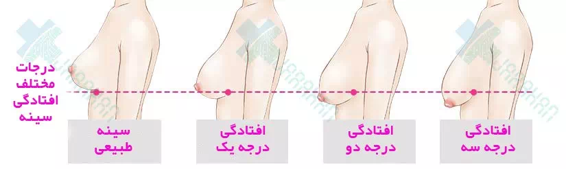 mammoplasty-infographic%20(9).webp