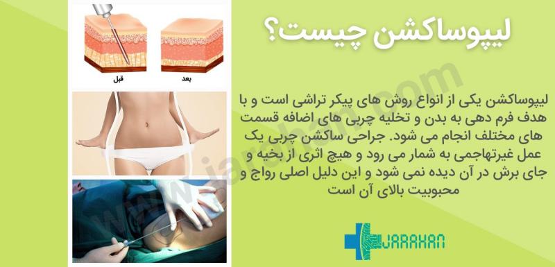 بعد از عمل بالن معده چی بخوریم+ابدو یا ابدومینوپلاستی چه عملی است+لیپوساکشن چگونه است+آیا عمل لیپوماتیک بیهوشی دارد