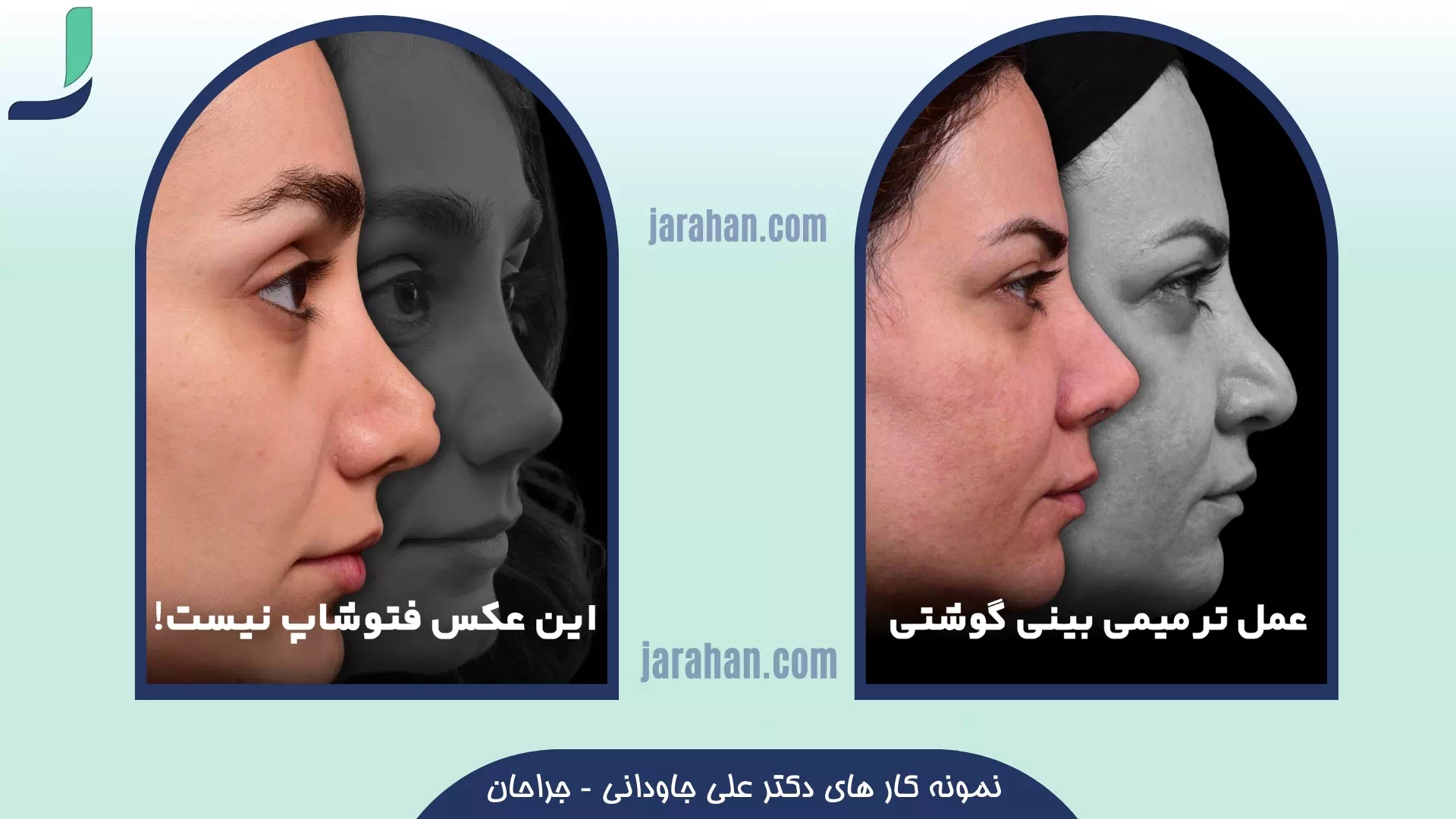 نمونه کار عمل بینی ترمیمی دکتر جاودانی