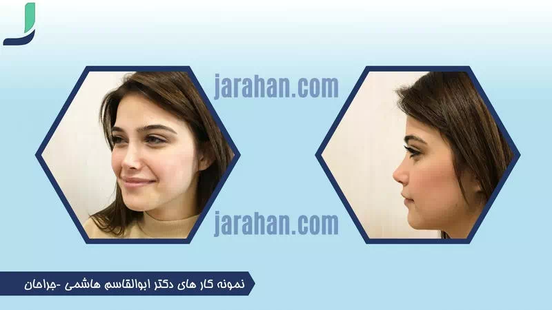 نمونه کار جراحی بینی دکتر ابوالقاسم هاشمی